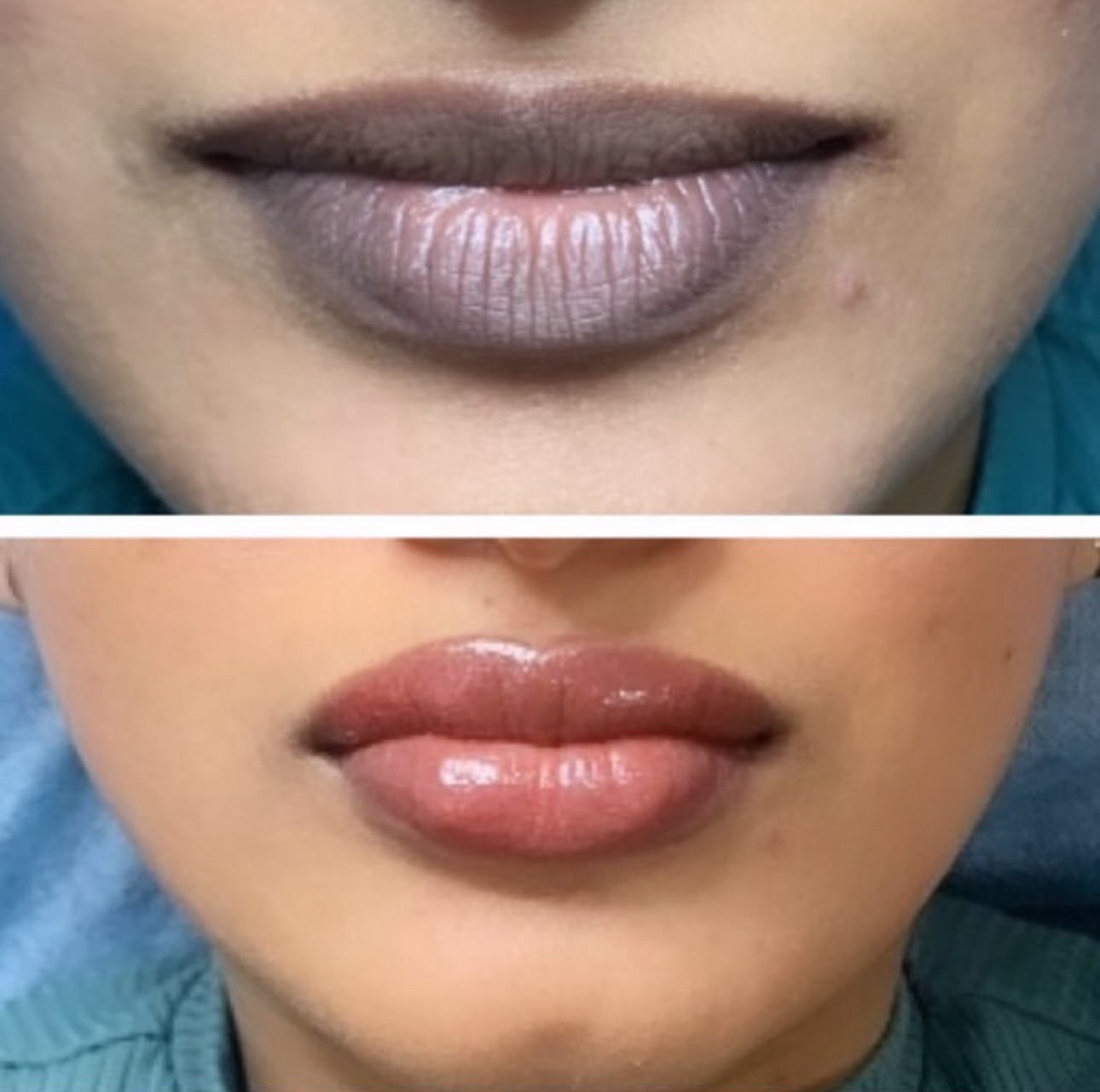 Lip Blush (Dark Lip Correction)