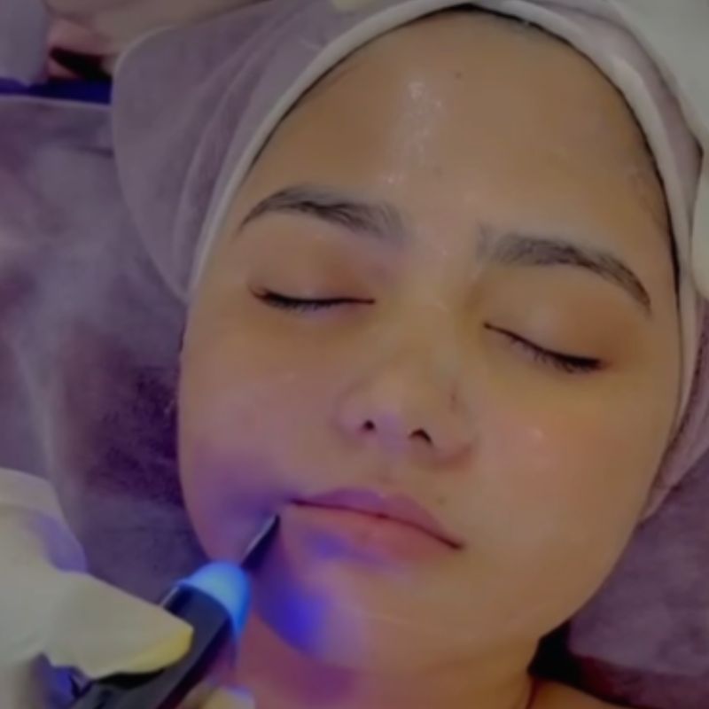Carboxy-Therapy Facial